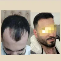 میخوای تضمینی باهزینه کمتر درشهر خودت کاشت مو کنی|خدمات آرایشگری و زیبایی|یزد, |دیوار