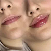 ژل /بوتاکس /سابسیژن در مشهد