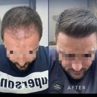 کاشت موی شیرازی|خدمات آرایشگری و زیبایی|مریوان, |دیوار