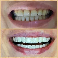 کامپوزیت دندان درمحل شمامنزل یامحل کار|خدمات آرایشگری و زیبایی|هشتگرد, شهرک گلخانه|دیوار