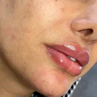 ژل لب بینی کانتورینگ بلفارو غبغب لیفت شقیقه ابرو