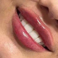 فیلر لب ۸۰۰