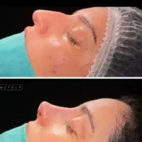 عمل بینی و جراحی لیفت صورت لیپو و ابدو