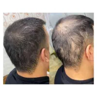 احیای تخصصی مو با متد روز دنیا