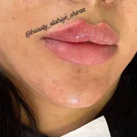 تزریق فیلر ،ژل و بوتاکس با دستگاه|خدمات آموزشی|شیراز, گویم|دیوار