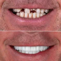 کامپوزیت ایمپلنت ارتودنسی بندرعباس|خدمات آرایشگری و زیبایی|بندرعباس, |دیوار