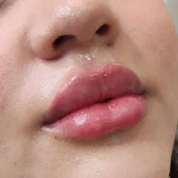 بوتاکس،ژل لب روسی،لیزر|خدمات آرایشگری و زیبایی|اسلام‌شهر, شهرک واوان|دیوار