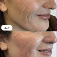 هایفو صورت( جوانسازی و لیفت قوی) یک جلسه فقط ۱/۵۰۰