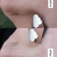 ژیکان لیزر موهای زائد،ریمو تتو،فشیال|خدمات آرایشگری و زیبایی|قم, زنبیل آباد|دیوار