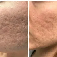 سابسیژن پوست انجام می شود