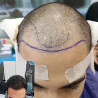 کاشت مو ابرو لیزر ژل بوتاکس مزو واکسن زگیل تناسلی|خدمات آرایشگری و زیبایی|اندیشه, اندیشه فاز ۱|دیوار
