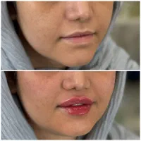 جشنواره ویژه ژل و بوتاکس مطب دکتر رویا جعفری|خدمات آرایشگری و زیبایی|اهواز, کوی علوی|دیوار