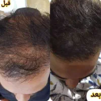 درمان ریشه ای ریزش مو