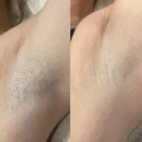 لیزر موهای زائد  رهایی از اصلاح و موهای زیرپوستی