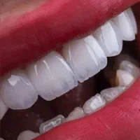 کامپوزیت زیبایی درمانی|خدمات زیبایی و سلامت|تهران, تهرانپارس جنوبی|دیوار