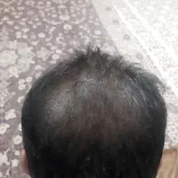 میکرواسکالپ