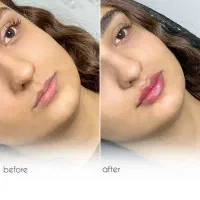 لیزر پی ار پی ژل لب بوتاکس مزو مو فیلر باسن بیکینی