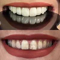 ونیر کامپوزیت ژاپنی اصل (تعرفه دولتی + اقساط)|خدمات آرایشگری و زیبایی|علیآباد کتول, |دیوار