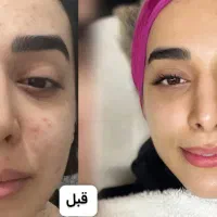 پاکسازی،فیشال درمان مشکلات پوستی