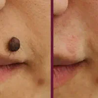 حذف تخصصی خال وزگیل