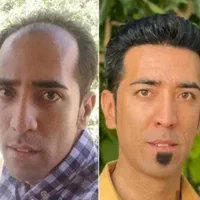 کاشت مو طبیعی،ابرو،و ریش بدون ورم و حتی کبودی