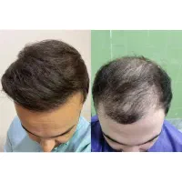 کاشت مو طبیعی / تراکم بالا طبیعی ۱۰ میلیون تخفیف