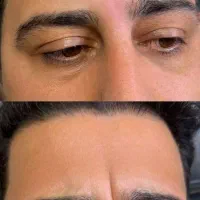 تزریق ژل و بوتاکس|خدمات آرایشگری و زیبایی|رشت, بوسار|دیوار