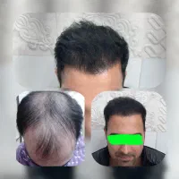 کاشت موی حرفه ای ،زیبایی در نهایت ظرافت|خدمات آرایشگری و زیبایی|تربتحیدریه, شهید قرنی|دیوار