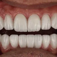 دندانپزشکی،ایمپلنت،اوردنچر با اقساط دو ساله|خدمات آرایشگری و زیبایی|اهر, |دیوار