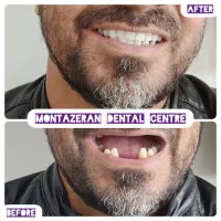 دندانسازی دندانساز دندان مصنوعی دندان باضمانت|آرایشی، بهداشتی، درمانی|مشهد, کوشش|دیوار