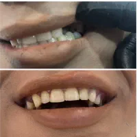 دندان سازی مروارید۳۰٪ اف|خدمات آرایشگری و زیبایی|بهبهان, |دیوار