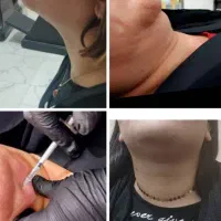 آموزش ژل و بوتاکس تضمینی