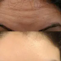 بوتاکس درخانه