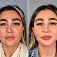 جشنواره فیلر بادی ، فول فیس ، بوتاکس