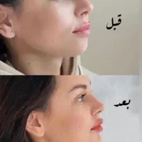 کلینیک تخصصی  خدمات زیبایی(ژل و بوتاکس ) با تخفیف|خدمات آرایشگری و زیبایی|کاشان, فین کوچک|دیوار