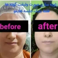 لیزر خانم آقا ژل بوتاکس هایفو لاغری امبدینگ|خدمات آرایشگری و زیبایی|سیرجان, |دیوار