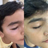 درمان گیاهی بیماری پیسی وپسوریازیس