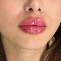 نیازمند مدل فیلرلب/چانه/گونه/زاویه/بوتاکس|خدمات آرایشگری و زیبایی|کرج, گلشهر|دیوار