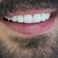 کامپوزیت دندان از ۳تومن با شرایط اقساطی