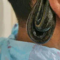 حجامت،فصد،زالو