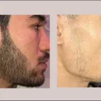 اگه حتی پرز هم نباشه بازم رویش انجام میشه