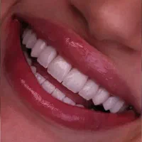 ۱۵درصد تخفیف روی خدمات ایمپلنت به مدت محدود|خدمات آرایشگری و زیبایی|تبریز, |دیوار