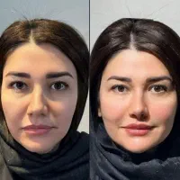تزریق فیلر و بوتاکس با بهترین متریال کره ای