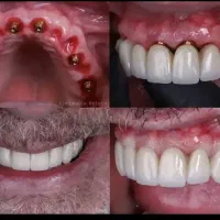 دندان پزشک روکش زیبایی ، ایمپلنت ، اوردنچر