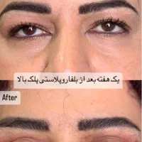 جشنواره پاییزه بلفاروپلاستی|خدمات آرایشگری و زیبایی|تهران, پاسداران|دیوار