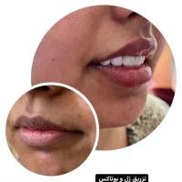 تزریقات ژل شروع قیمت از 750|خدمات آرایشگری و زیبایی|شیراز, شهرک مفتح|دیوار