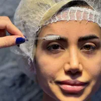 آموزش کاشت مو و ابرو به روش های نوین پزشکی|خدمات آموزشی|تهران, سعادت‌آباد|دیوار