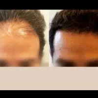 کاشت مو وزیبایی بدن اقساطی|خدمات آرایشگری و زیبایی|تبریز, |دیوار