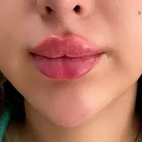 بوتاکس ژل و فیلر مزو آنزیم غبغب