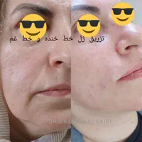 مطب دکتر کژال شاه ویسی تزریق ژل بوتاکس مزوژل